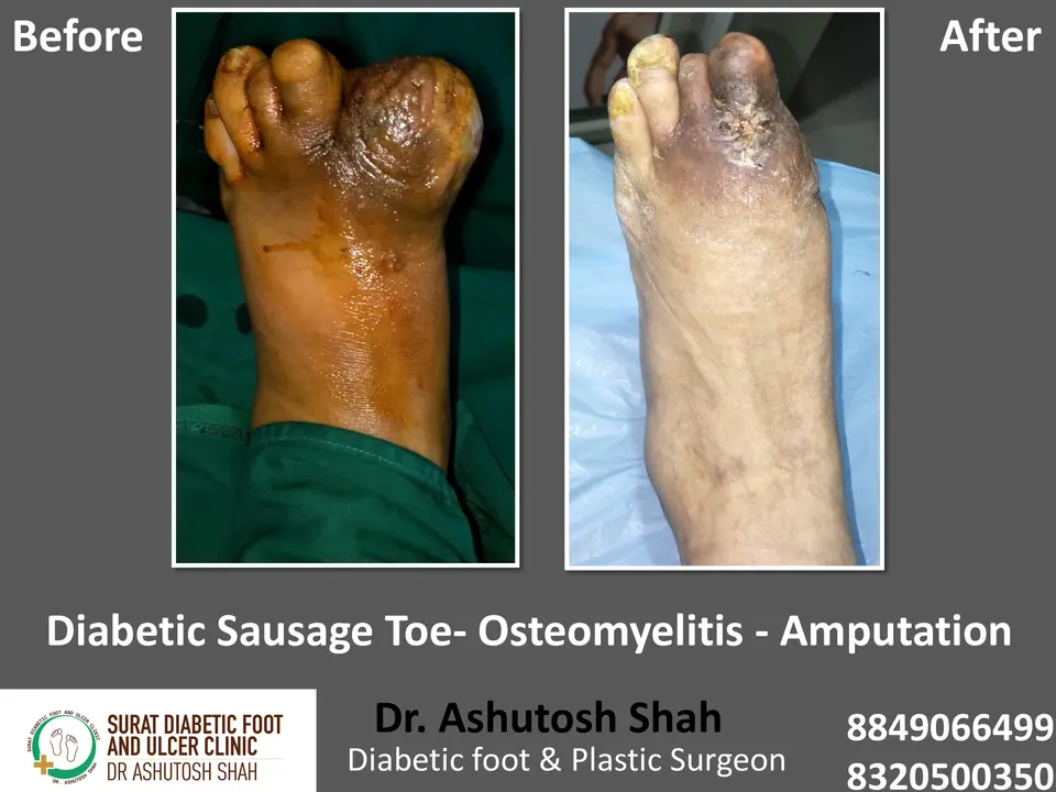 Diabetic Foot  PPT 3 checked by sir.pptx-100.webp